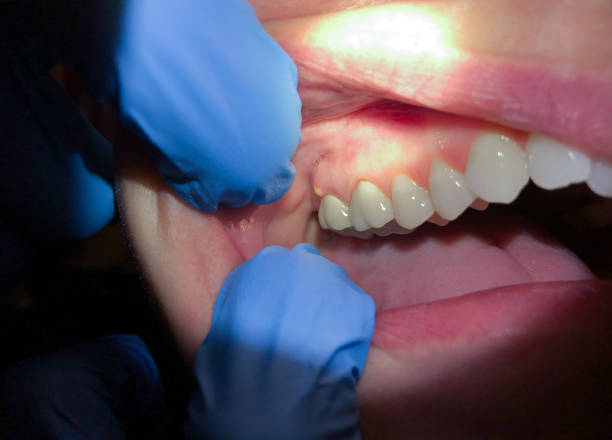 Best Dentist for Tooth Abscess  in Lumberton, NC